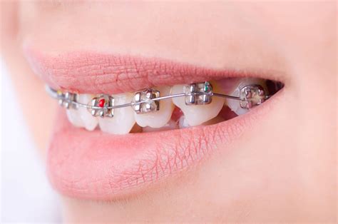 metal en el paladar brackets|que deben tener los brackets.